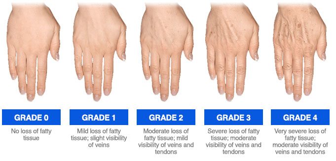 Merz Hand Grading Scale