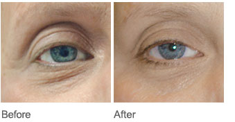 Neocutis Before and After example 1