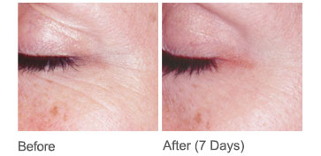 Neocutis Before and After example 2